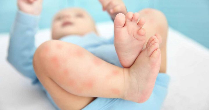 Alergi pada Kulit Bayi