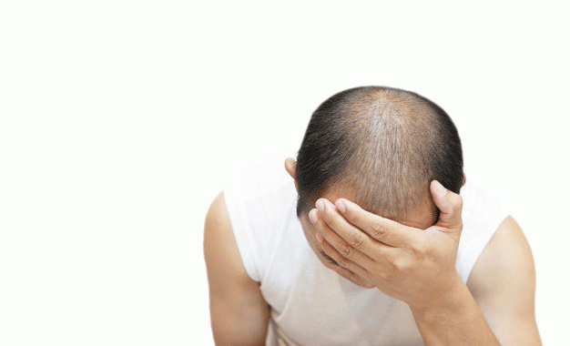 Masalah Kebotakan Rambut Pria