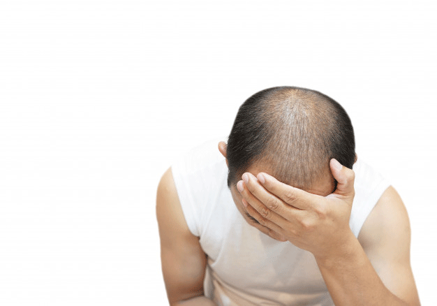 Masalah Kebotakan Rambut Pria